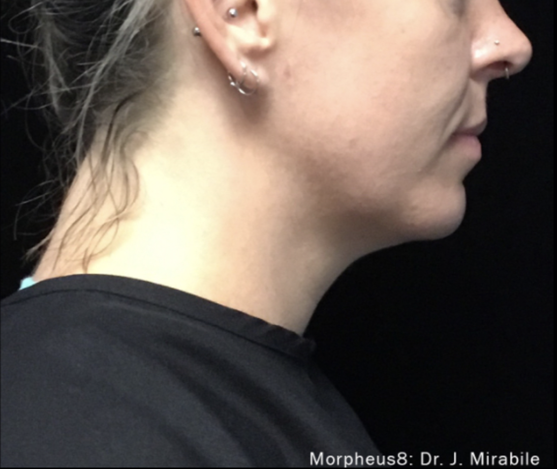 Morpheus8 (Glow Lift) After