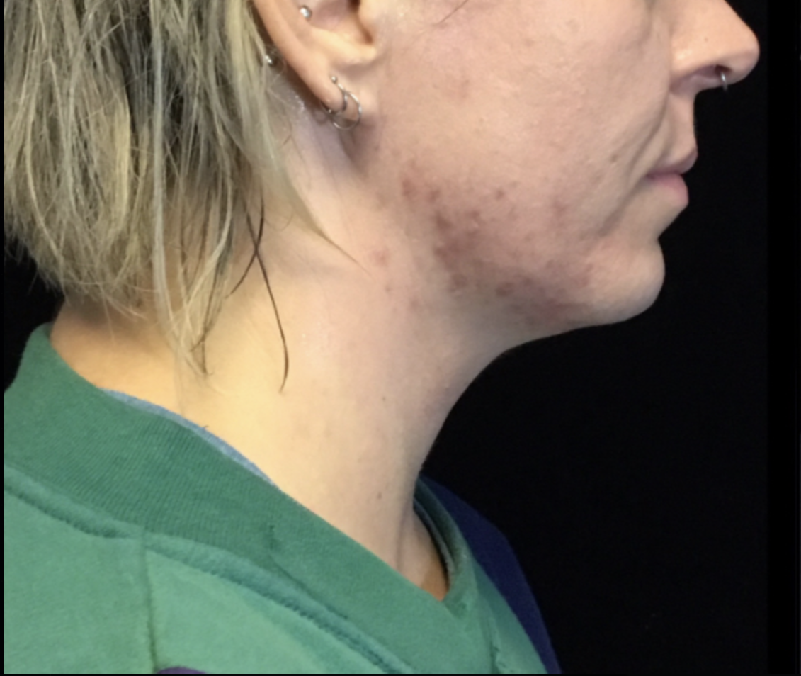 Morpheus8 (Glow Lift) Before