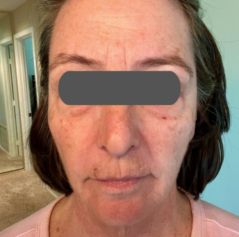 PRF (Glow Renew) AFTER