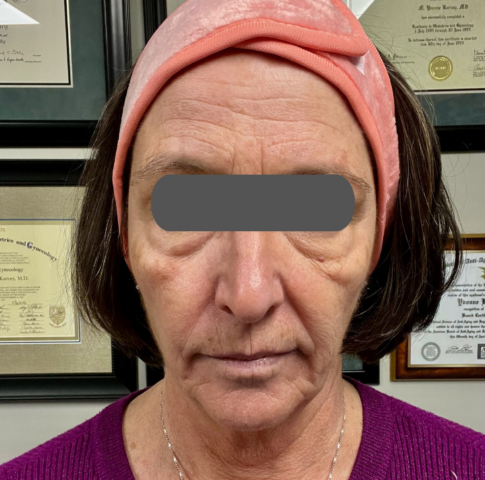PRF (Glow Renew) BEFORE
